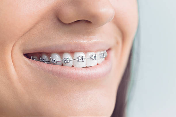 Best Veneers and Lumineers  in Fairview Park, OH
